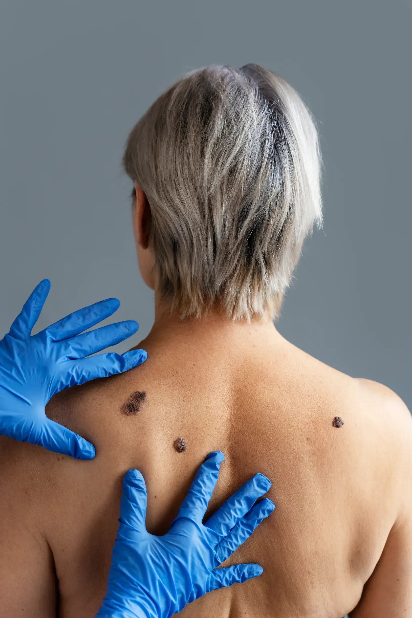 What Is Skin Tag Removal?