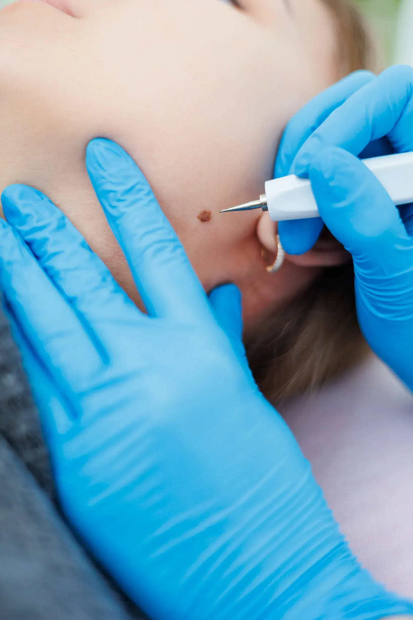 Who Is a Good Candidate for Skin Tag Removal?