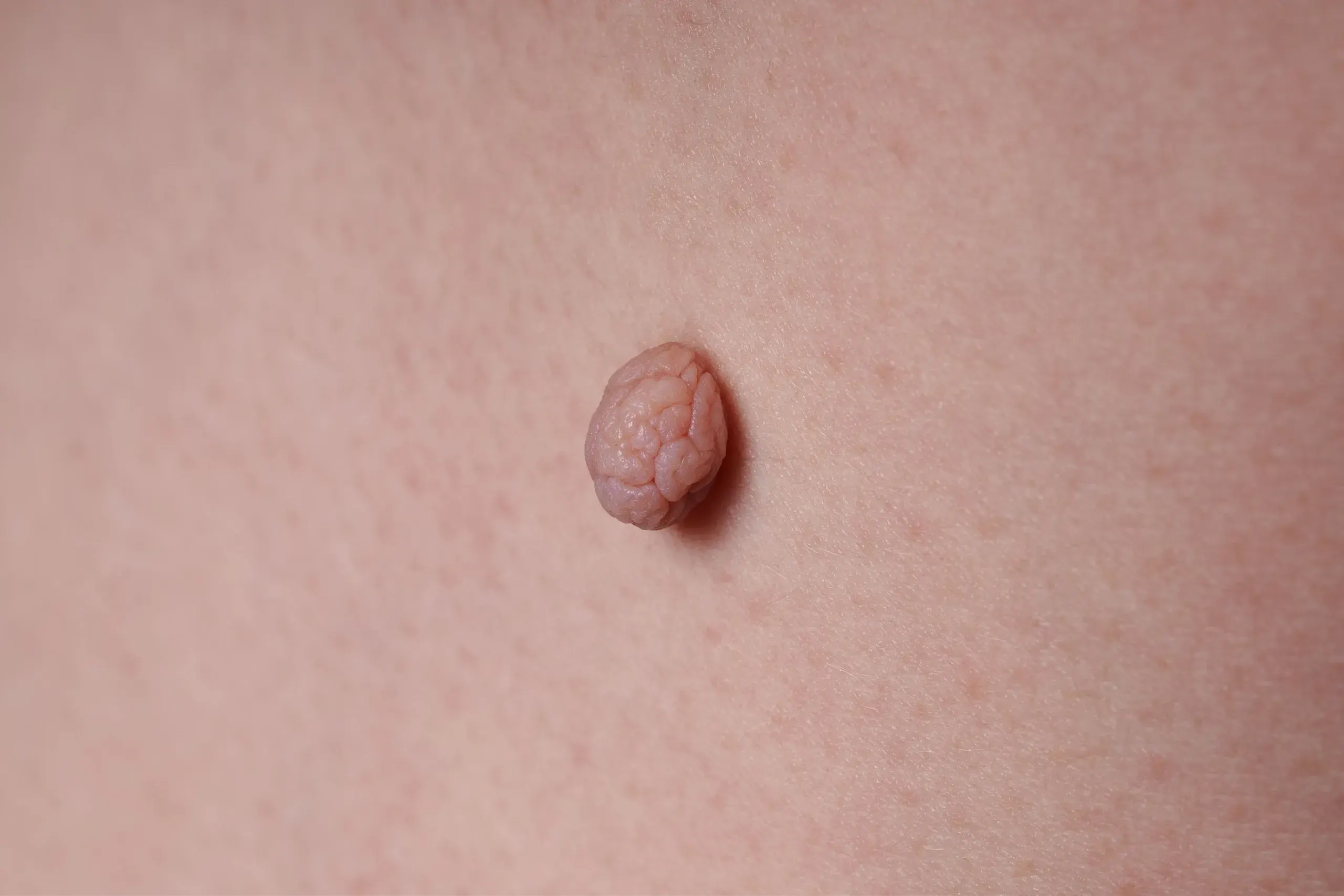illustration of common benign skin growths and lesions at Paradise Family Healthcare Venice FL